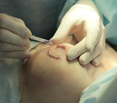 Внутрипротоковая папиллома молочной железы: как лечить?